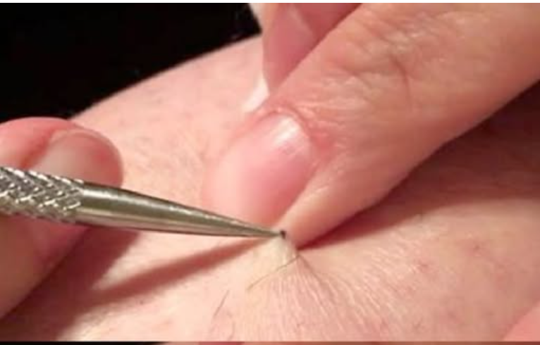 It all started with an itch, and ultimately, a shock! A man found a black spot on his leg and started to pick it off… what he removed left millions of people speechless.