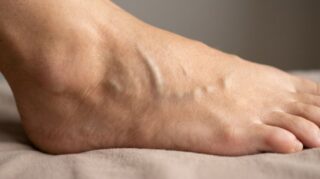Swollen vein on top of foot: simple discomfort or a real emergency?