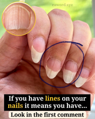 If you have stripes on your nails, it means you have… See more