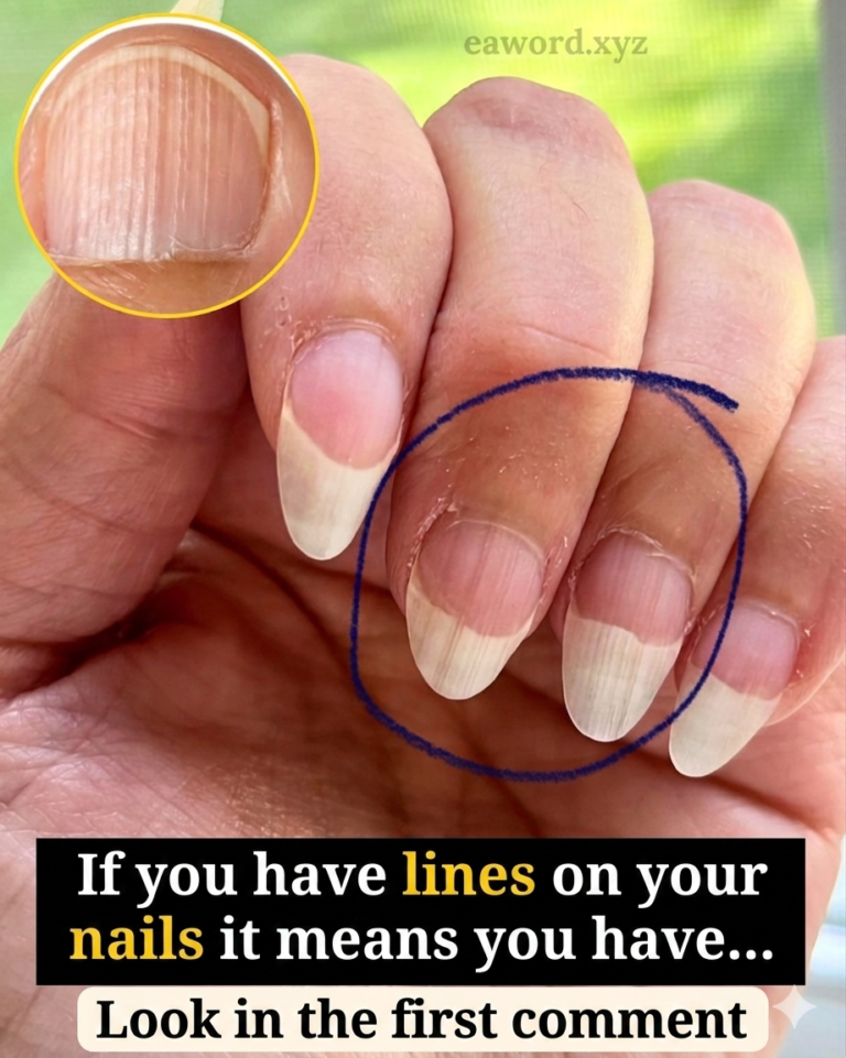 If you have stripes on your nails, it means you have… See more